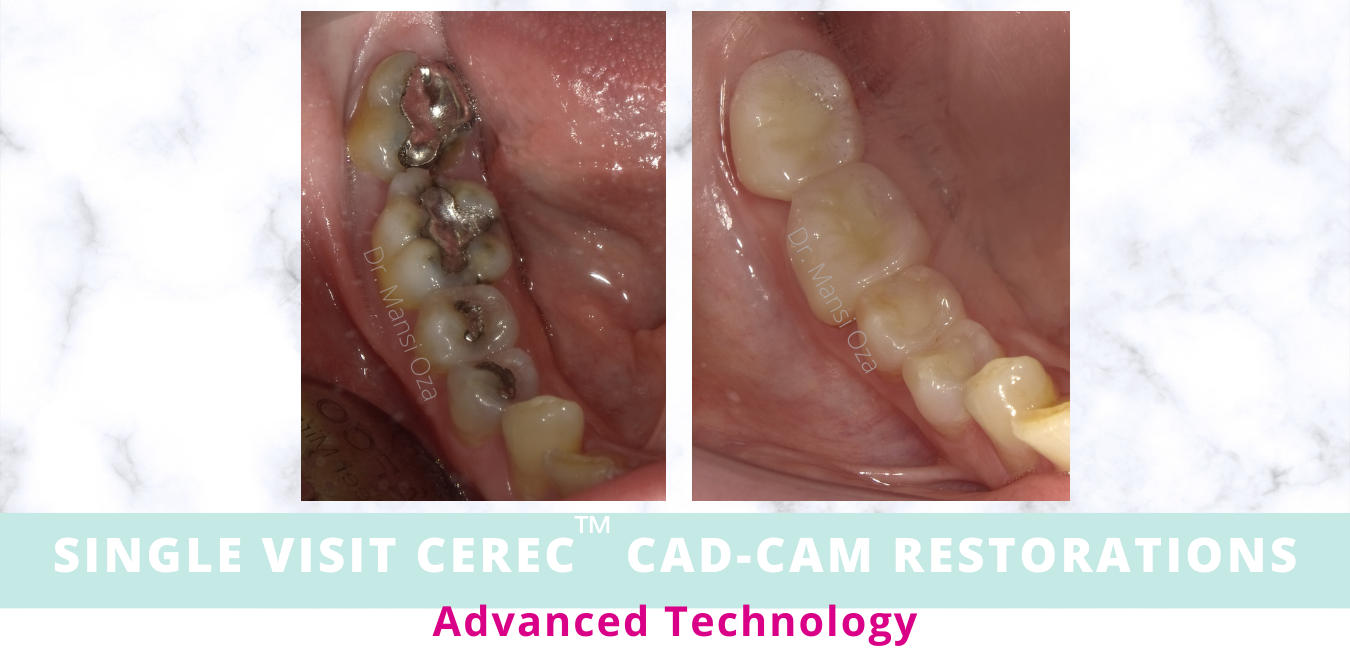 Can Fillings Look Like Your Natural Teeth? - TruCare Dentistry