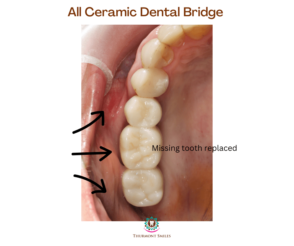 All Ceramic Dental Bridge