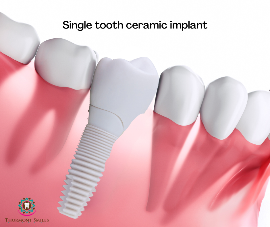 Single tooth ceramic implant