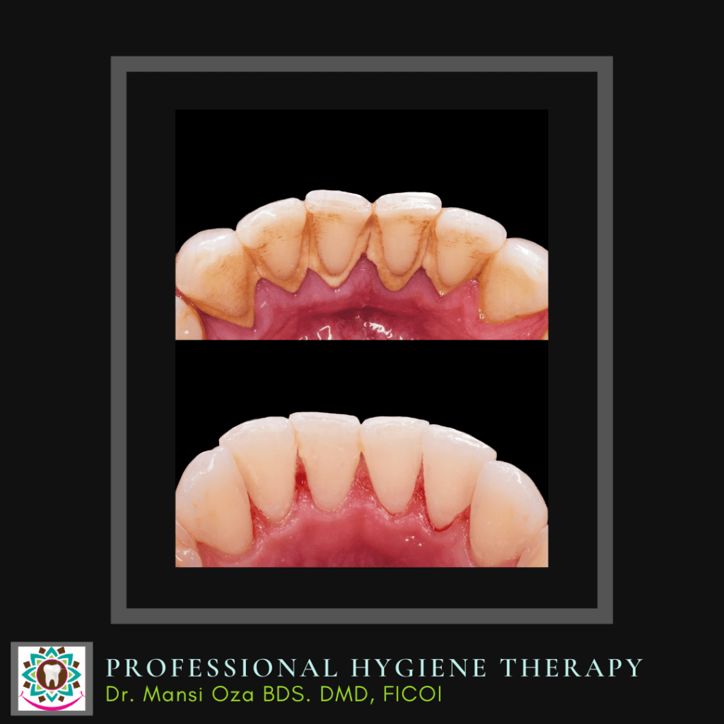 Gum treatment